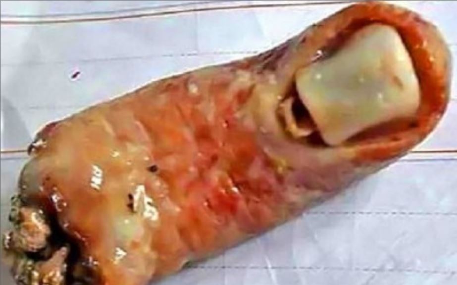 माछाको सुपमा मान्छेको औला भेटीयो ! के यो सत्या हो ?