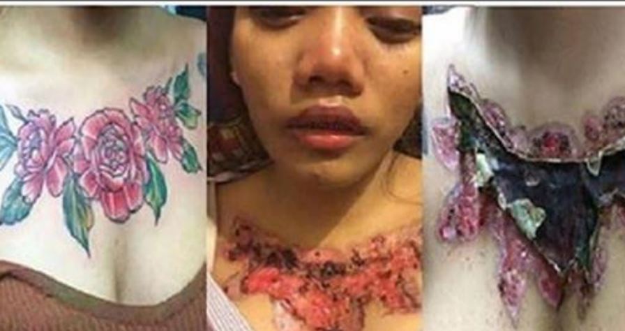 घाँटीमा खोपको टाटु हटाउन खोज्दा युवतीको भयो यस्तो बेहाल : घाउले लियो डरलाग्दो रुप, यसरी पोखिन् आफ्नो दु:ख