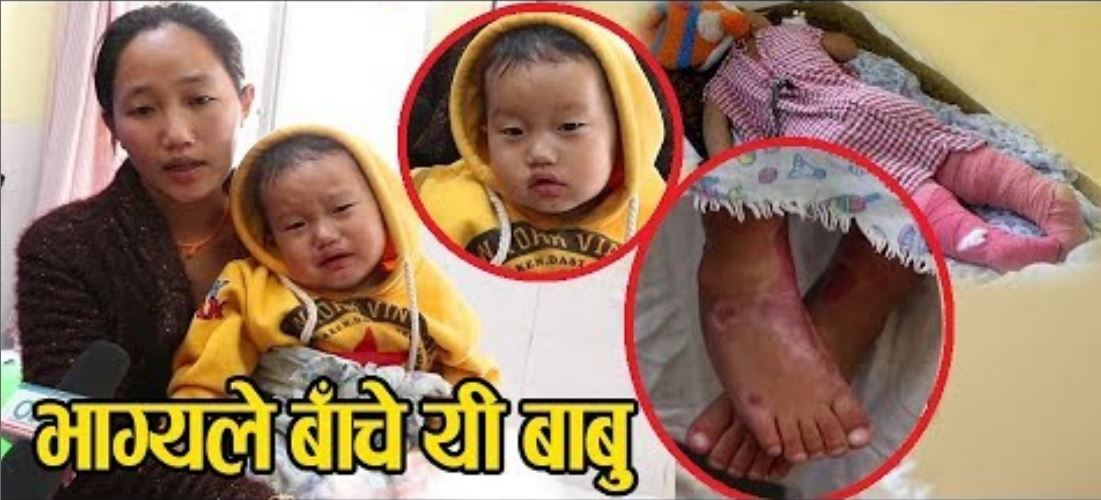 तातो दुधमा डुबेका बालक दैवले बचाए ! हेर्नुहोस यी बालकको दर्दनाक अवस्था (भिडियो)