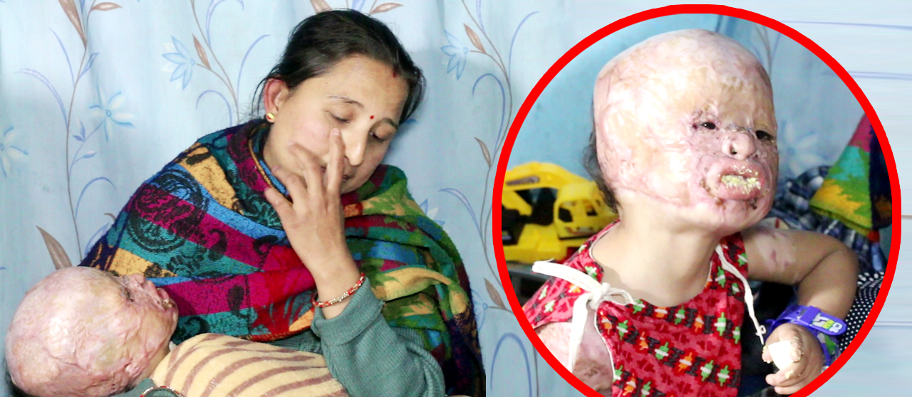 तेलमा डुबेर कुरूप भएका २ बर्षीय बालक रुदै भन्छन ‘म आफैलाई भुत जस्तै लाग्छ’-अन्तरबार्तामा रुदारुदै आमाको होस् गुम्यो