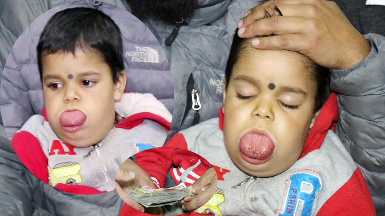 खान खाने मुखनै छैन यी बालकको :३ बर्षीय बालकको यस्तो कारुणिक अबस्था,बोल्न पनि सक्दैनन्